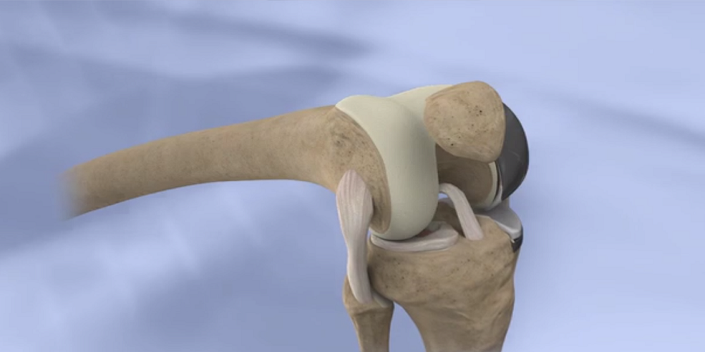 Orthopedic-Joint-replacement